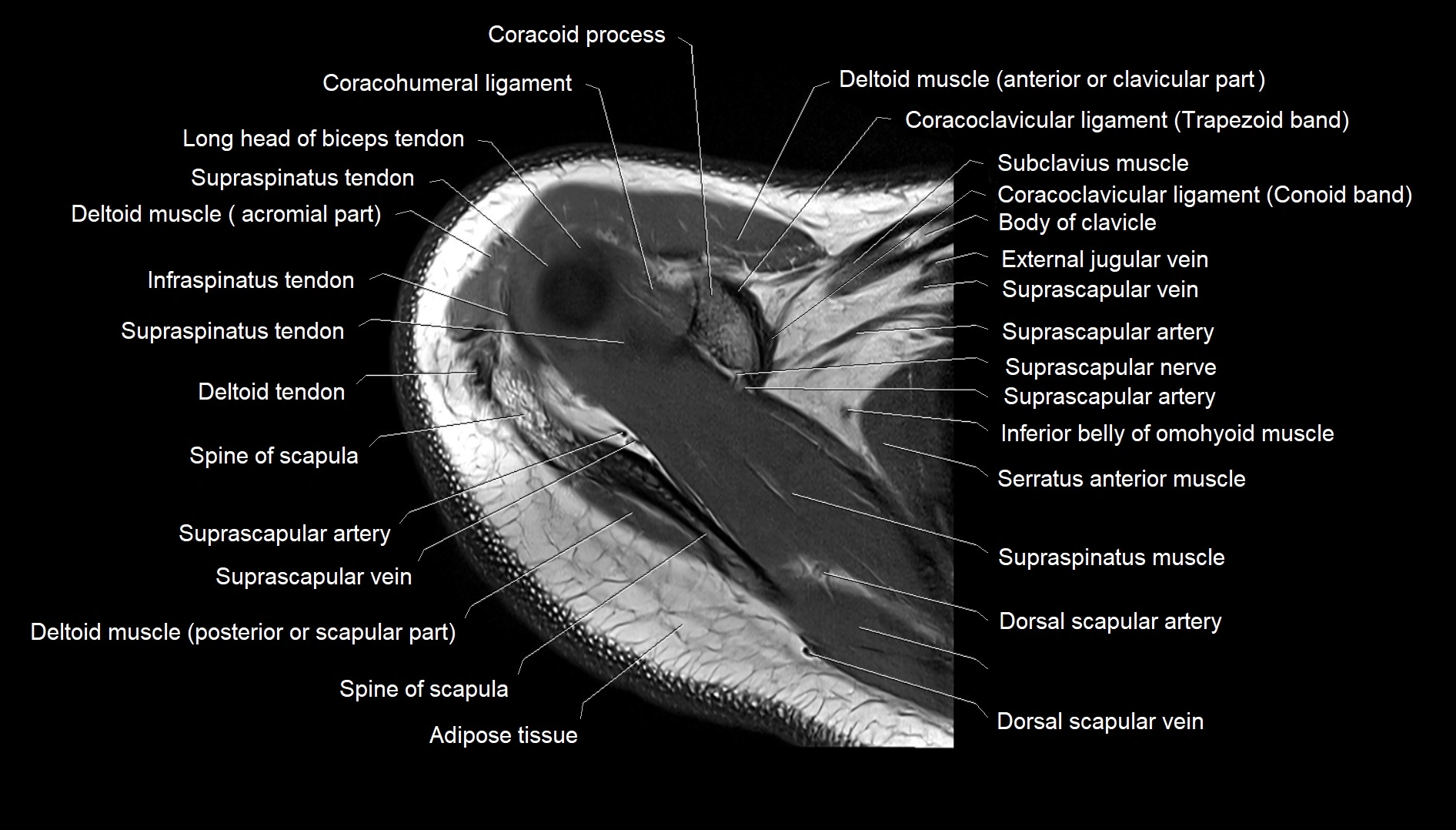 Shoulder cross sectional anatomy MRI 3T axial image 10.webp